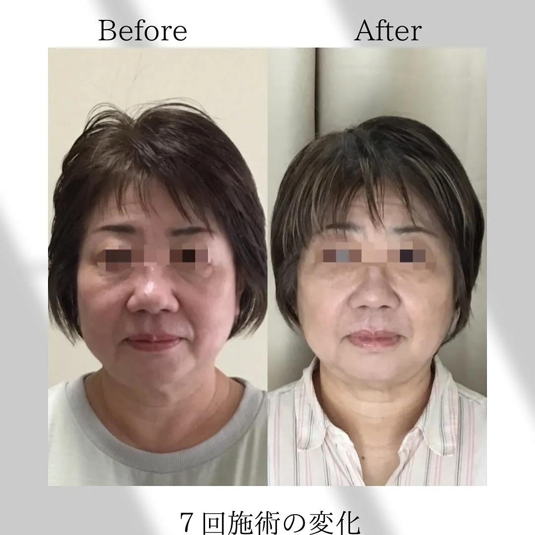 【西宮北口の美容鍼】顔のたるみが気になる方へ|根本改善を目指す美容鍼
