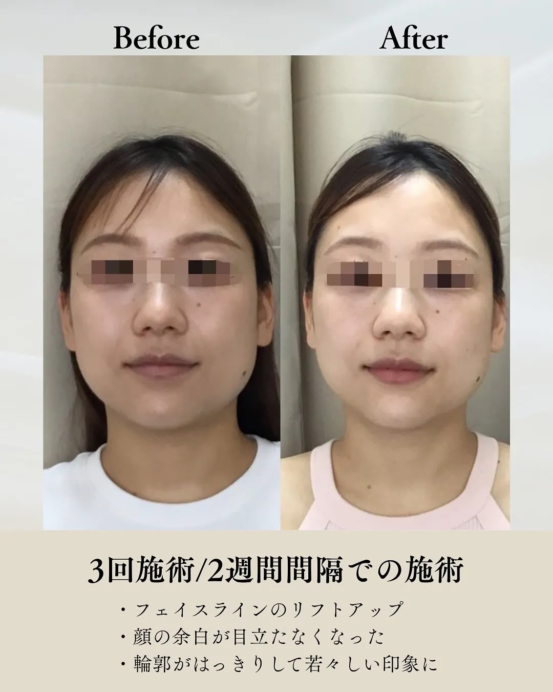 【西宮北口の鍼灸院】美容鍼は痛い?内出血の不安を解消する施術とは